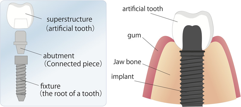 Sacramento dental implants